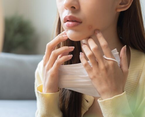 A young woman worries about her folliculitis problem and uses her hand to touch the acne around the chin and mouth