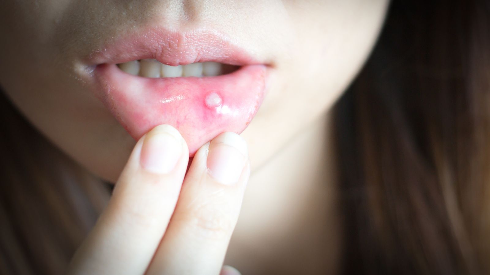 Because of canker sore, Asian woman has aphthae on the lip