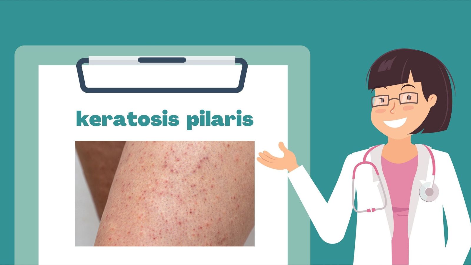 Close-up of a female doctor with a lab coat in her office pointing at the medical clipboard and explaining keratosis pilaris