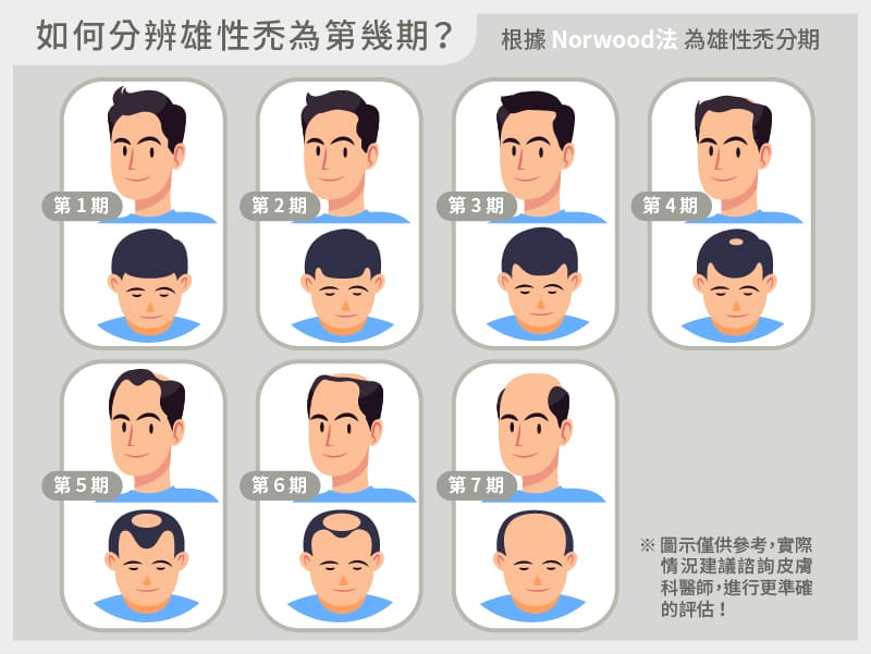 The Norwood scale classifies male pattern baldness into seven stages.