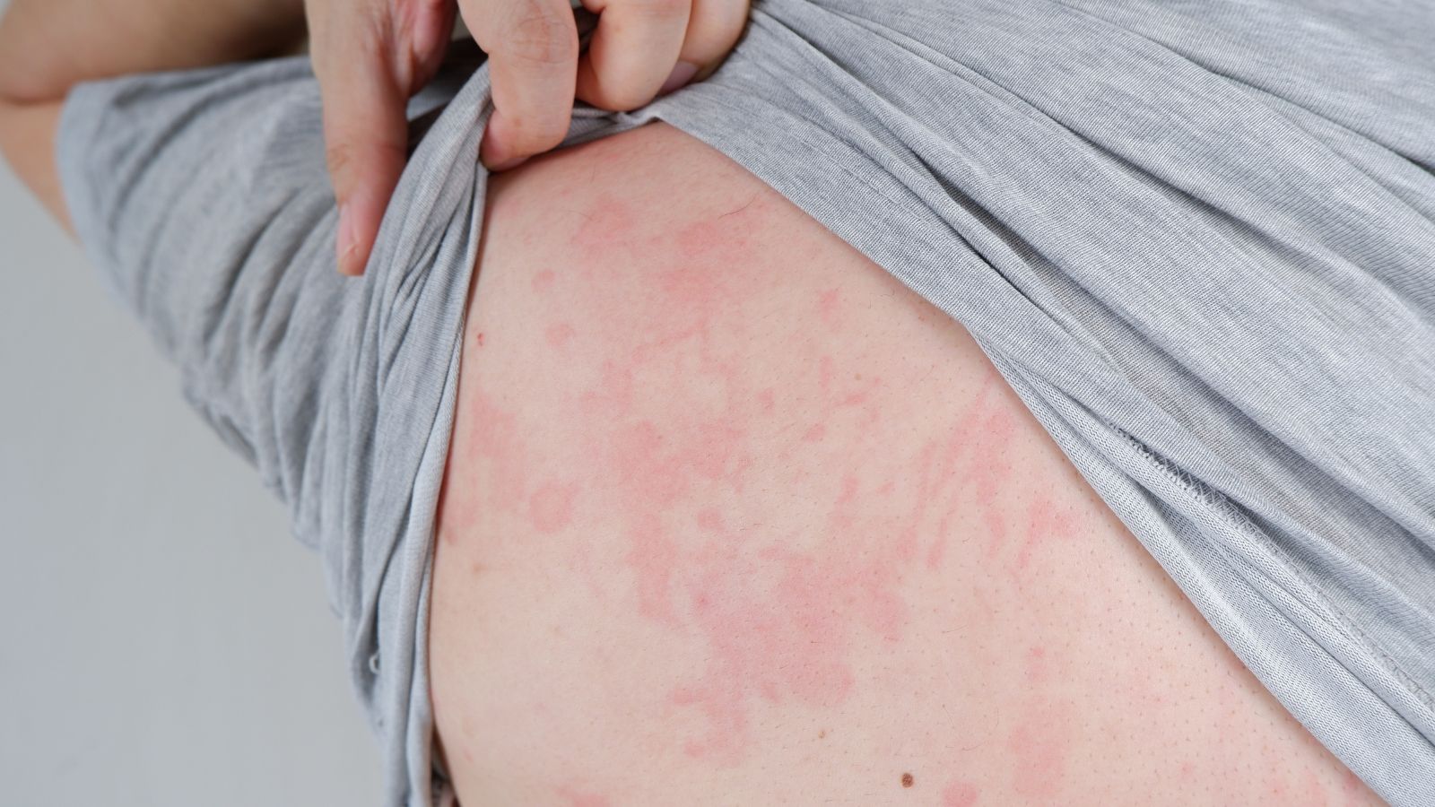 Close-up image of skin suffering severe urticaria on the back.