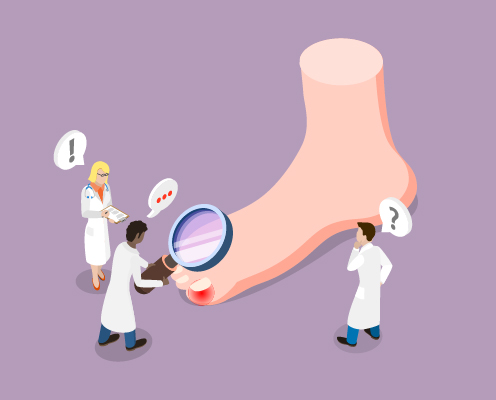 The doctor examined the patient's paronychia condition on the foot using a magnifying glass and discussed the symptoms with other doctors.