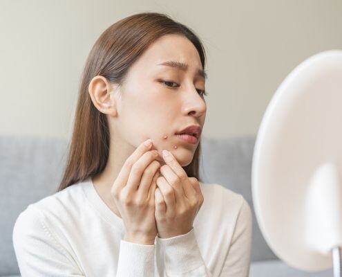An Asian woman expresses concern as she touches acne around her chin and mouth, contemplating squeezing the acne spots on her face.