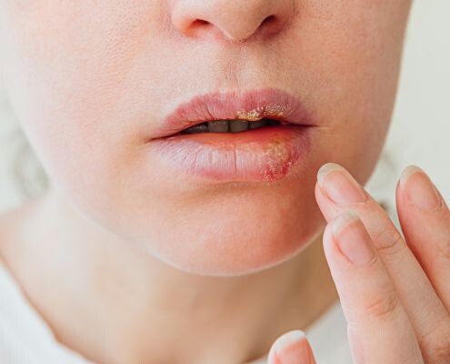 A young woman touched her face because her lips herpes hurt so bad.